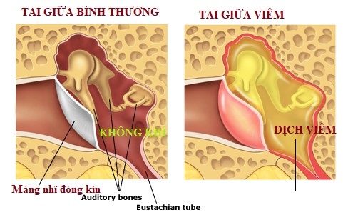 Vì sao thời gian điều trị viêm tai giữa thường kéo dài nhiều tuần?